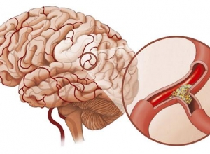 05 di chứng của nhồi máu não người bệnh sẽ phải đối mặt sau tai biến